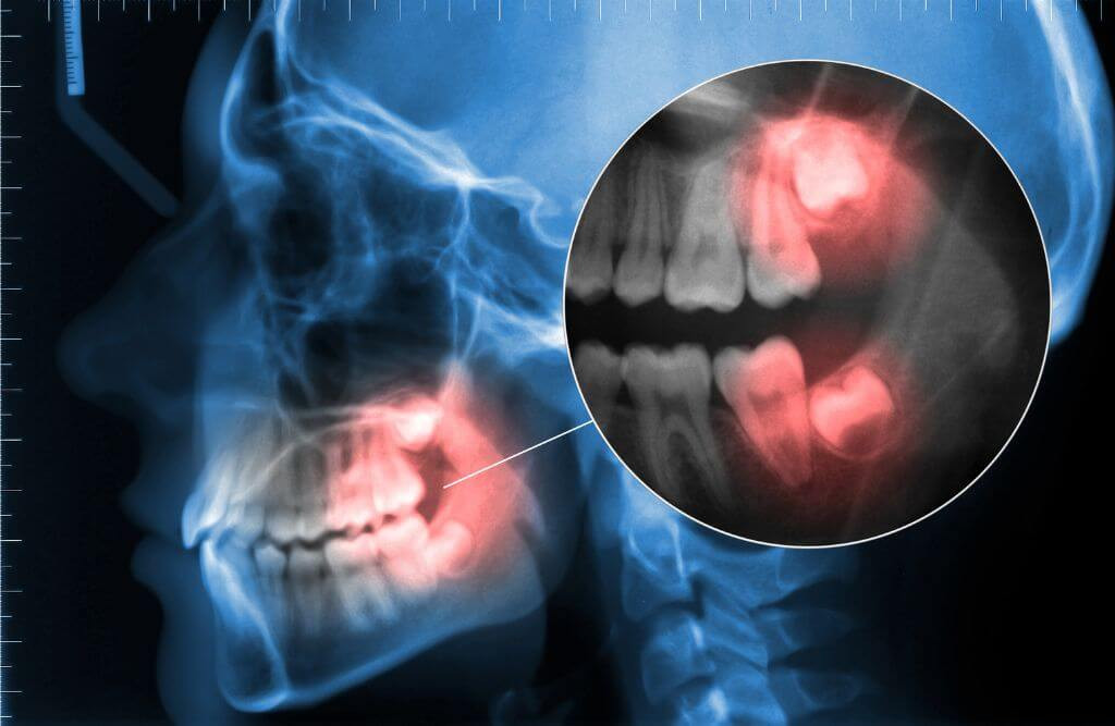 Wisdom teeth alignment