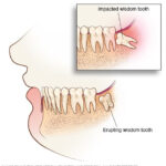 Swollen gums around wisdom teeth