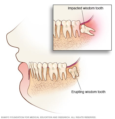Swollen gums around wisdom teeth